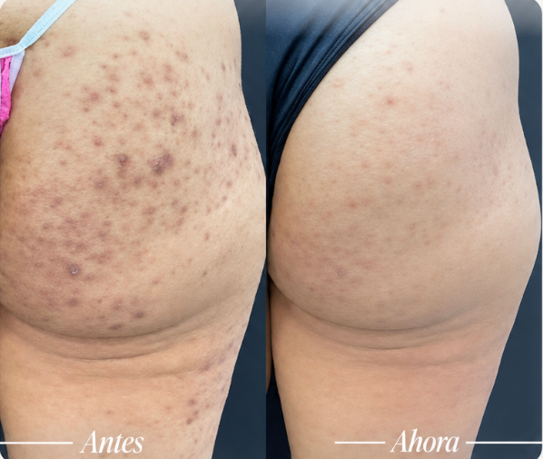 Exfoliante Anti-Foliculitis