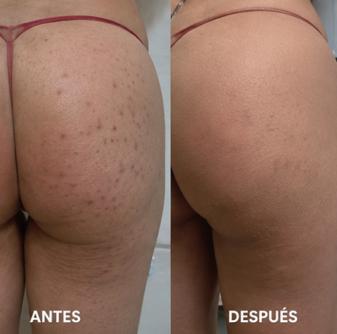 Exfoliante Anti-Foliculitis